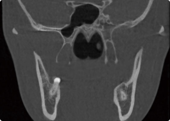 After cone-beam artifact reduction